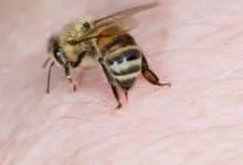 Is bee sting really fatal?
